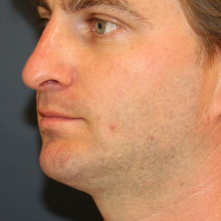 Before image 2 Case #111516 - Male Rhinoplasty with Chin Augmentation