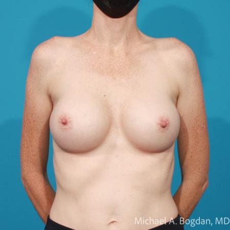 After image 1 Case #111746 - Breast Augmentation