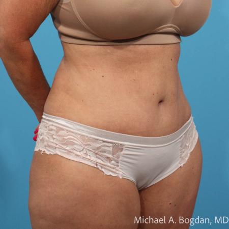 After image 2 Case #111801 - Abdominoplasty