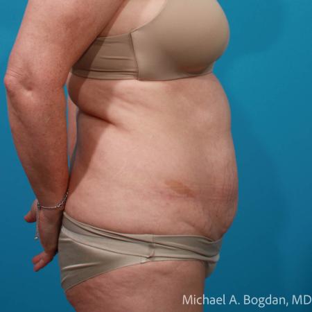 Before image 3 Case #111796 - Abdominoplasty