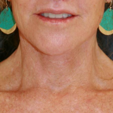 After image 1 Case #111531 - Female Necklift