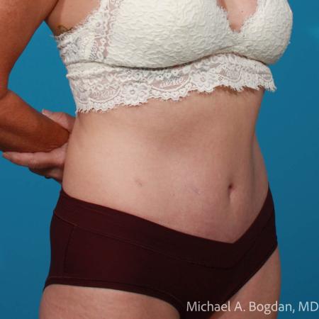 After image 2 Case #111916 - Abdominoplasty