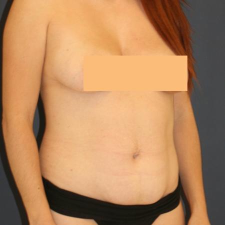 Before image 2 Case #111366 - Tummy Tuck (Abdominoplasty)