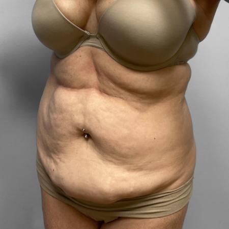 Before Case #111386 - Abdominoplasty with Liposuction