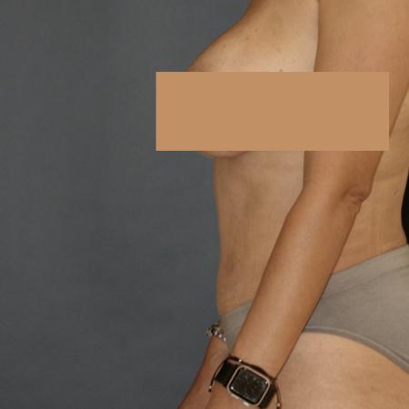 After image 3 Case #111586 - Tummy Tuck (Abdominoplasty)
