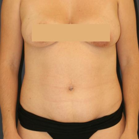 Before image 1 Case #111366 - Tummy Tuck (Abdominoplasty)