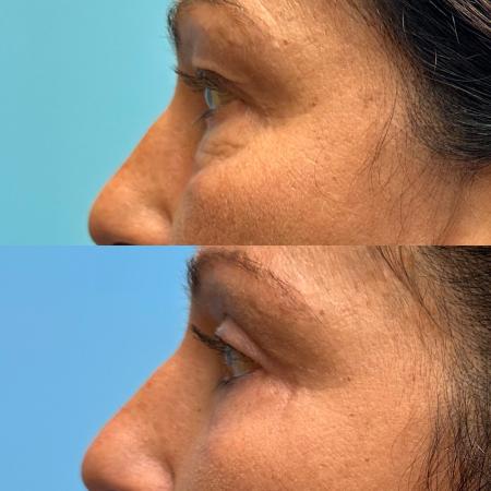 Before image 3 Case #111446 - Blepharoplasty 2