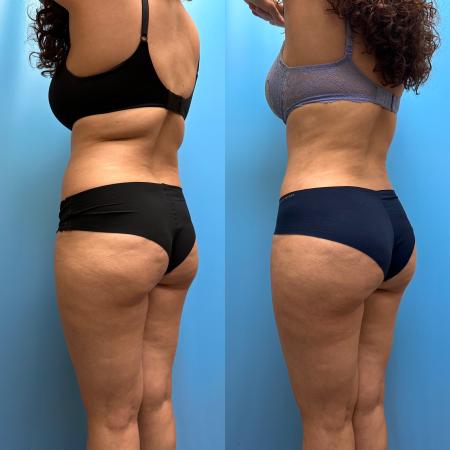 Before image 4 Case #110351 - Tummy Tuck, Lipo, Brazilian Butt Lift, Renuvion