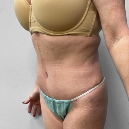 After Case #111386 - Abdominoplasty with Liposuction