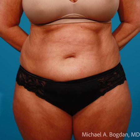 Before image 1 Case #111801 - Abdominoplasty