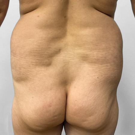 Before Case #111851 - Tummy Tuck, Lipo, & BBL