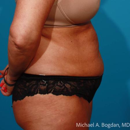 Before image 3 Case #111801 - Abdominoplasty