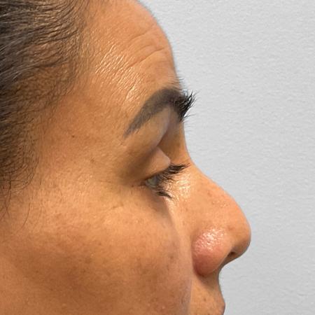 Before Case #111856 - Upper and Lower Blepharoplasty