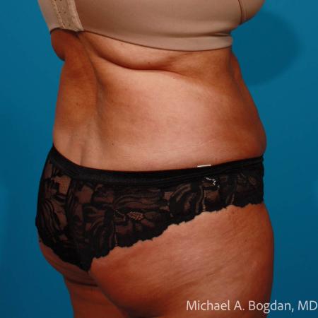 Before image 4 Case #111801 - Abdominoplasty