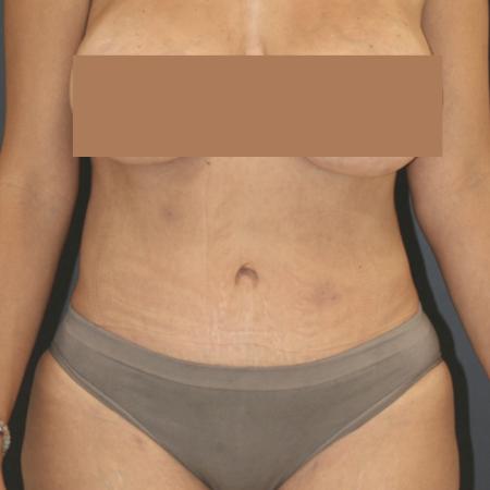 After image 1 Case #111586 - Tummy Tuck (Abdominoplasty)