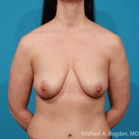 Before image 1 Case #111776 - Bilateral Breast Augmentation Mastopexy