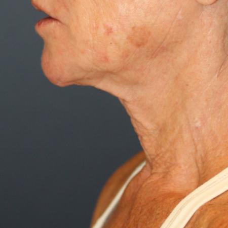 Before image 3 Case #111531 - Female Necklift