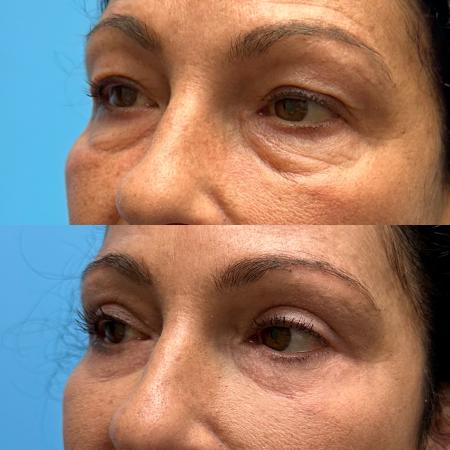 Before image 2 Case #111446 - Blepharoplasty 2