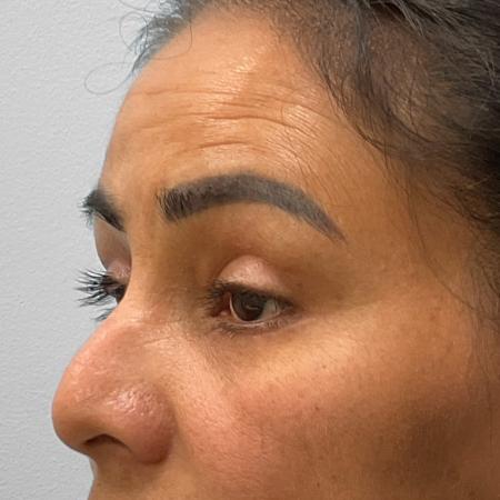 After Case #111856 - Upper and Lower Blepharoplasty