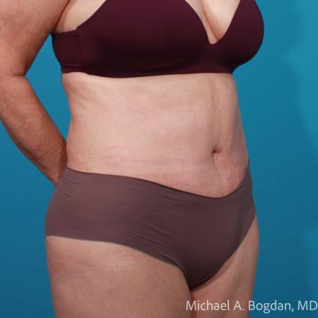 After image 2 Case #111796 - Abdominoplasty