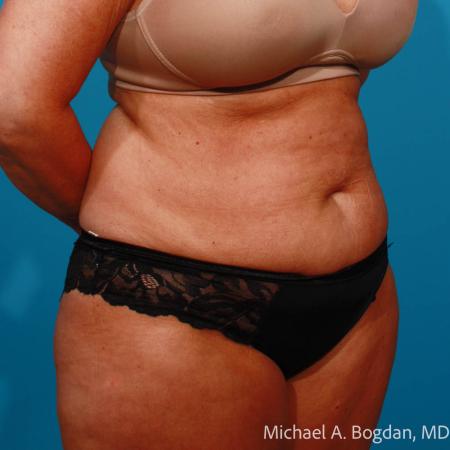 Before image 2 Case #111801 - Abdominoplasty