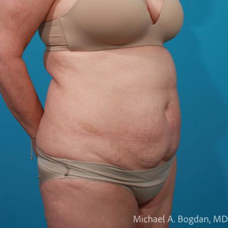 Before image 2 Case #111796 - Abdominoplasty