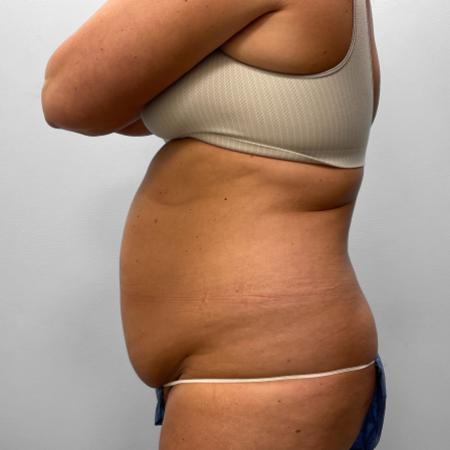 Before Case #111431 - Tummy Tuck & Liposuction