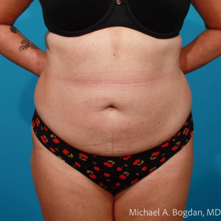 Before image 1 Case #111756 - Abdominoplasty
