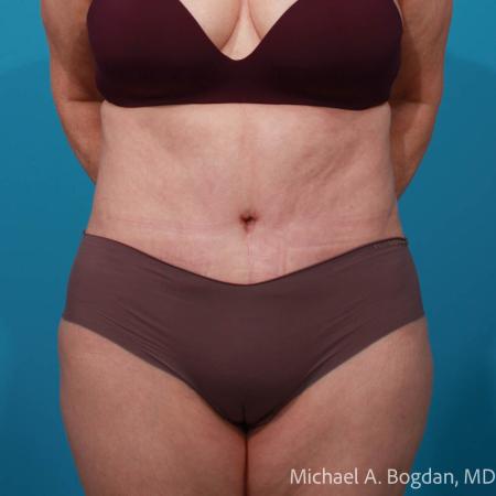 After image 1 Case #111796 - Abdominoplasty