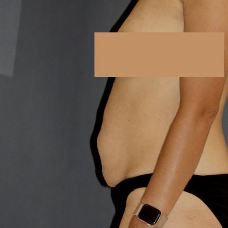 Before image 3 Case #111586 - Tummy Tuck (Abdominoplasty)