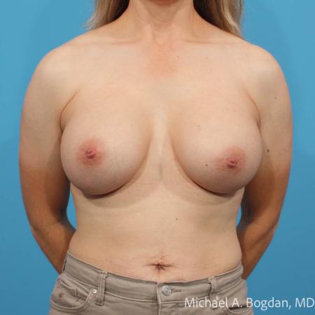 After image 1 Case #111926 - Breast Augmentation