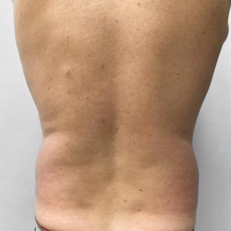 Before Case #111426 - Liposuction