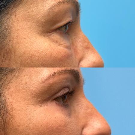 After image 3 Case #111446 - Blepharoplasty 2