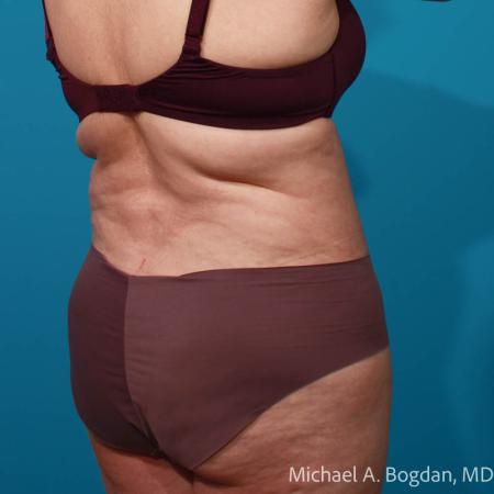 After image 4 Case #111796 - Abdominoplasty