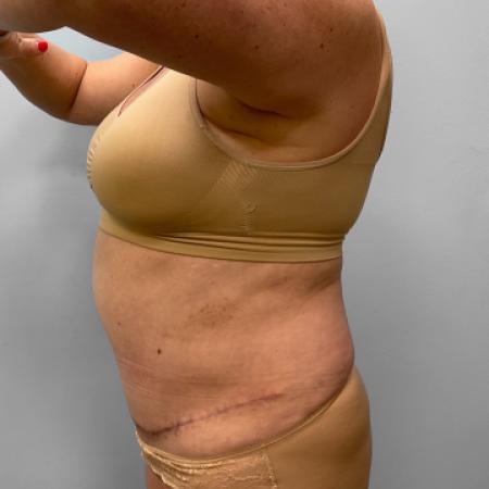 After Case #111416 - Tummy Tuck with Liposuction
