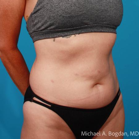 Before image 2 Case #111916 - Abdominoplasty