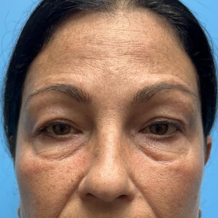 Before image 1 Case #111446 - Blepharoplasty 2