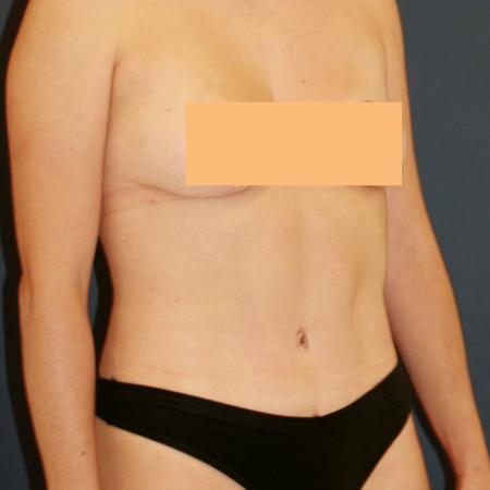 After image 2 Case #111366 - Tummy Tuck (Abdominoplasty)