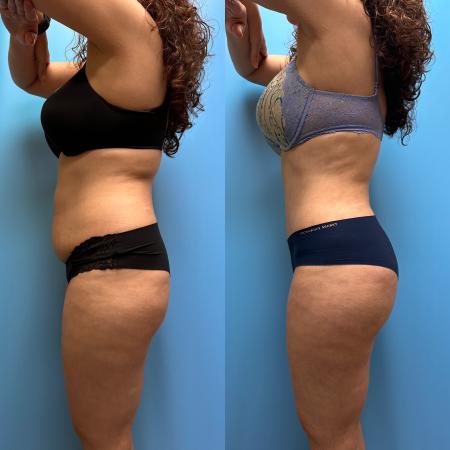 Before image 3 Case #110351 - Tummy Tuck, Lipo, Brazilian Butt Lift, Renuvion