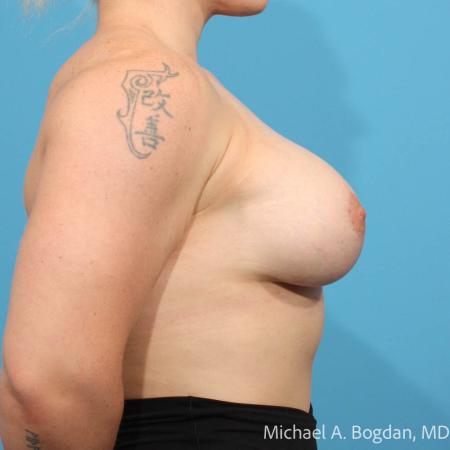 After image 3 Case #111511 - Breast Augmentation