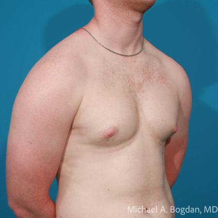 Before image 2 Case #112221 - Bilateral Gynecomastia Excision