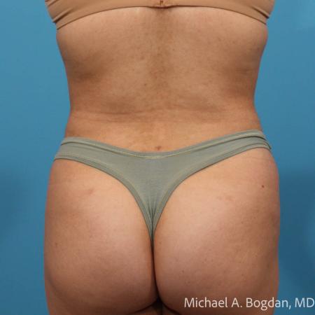After image 5 Case #112086 - Abdominoplasty