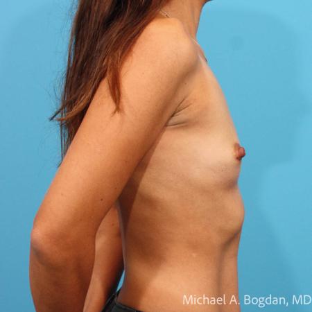 Before image 3 Case #112046 - Breast Augmentation