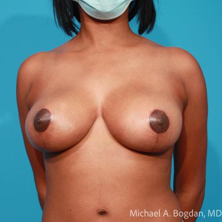 After image 1 Case #112091 - Breast Lift
