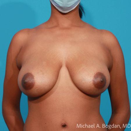 Before image 1 Case #112091 - Breast Lift