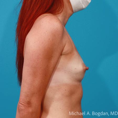 Before image 3 Case #112076 - Breast Augmentation
