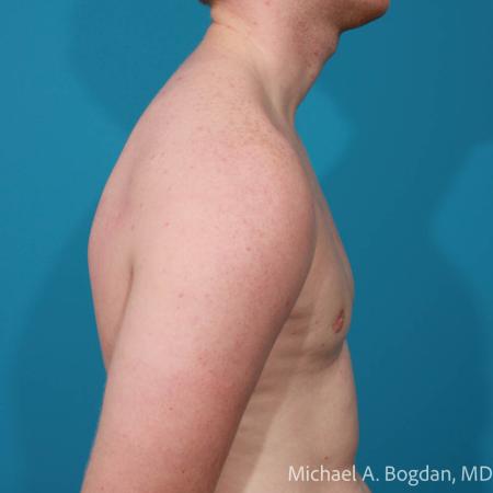 After image 3 Case #112221 - Bilateral Gynecomastia Excision