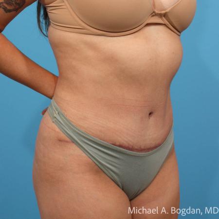 After image 2 Case #112086 - Abdominoplasty