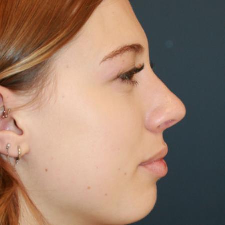 After image 3 Case #112101 - Female Rhinoplasty