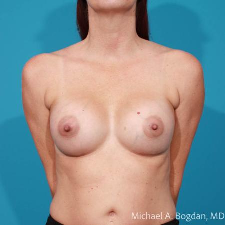 After image 1 Case #112076 - Breast Augmentation
